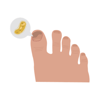 Fungus of the nails (onychomycosis) and feet (epidermophytosis)