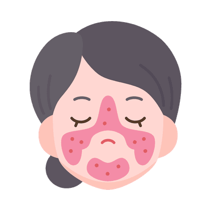 Couperose (vascular asterisks)